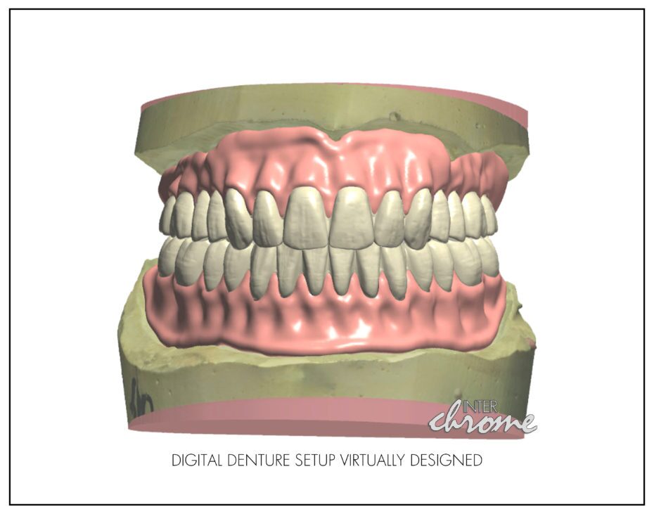 virtual denture setup