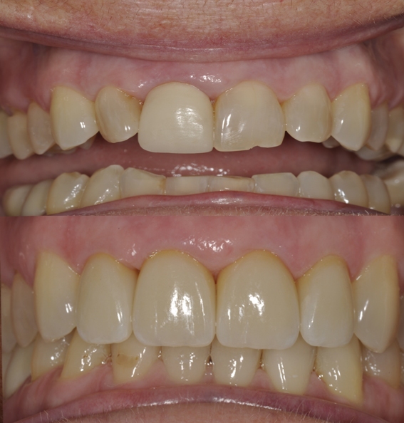 emax veneers
