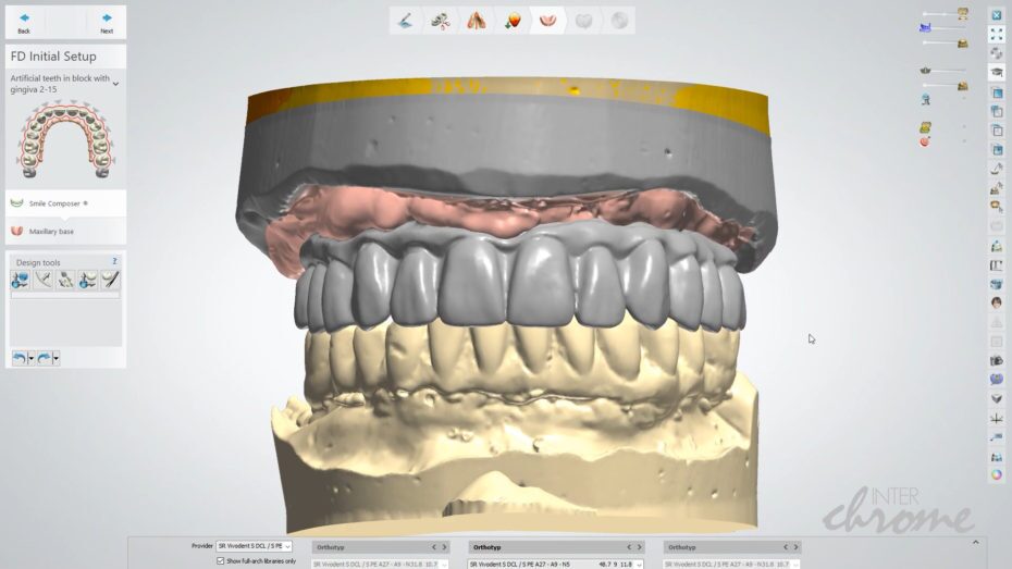 digital denture design for hybrid