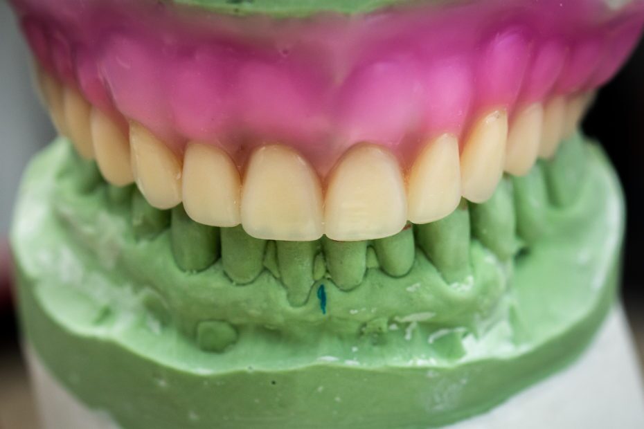 Immediate Denture - Full Setup