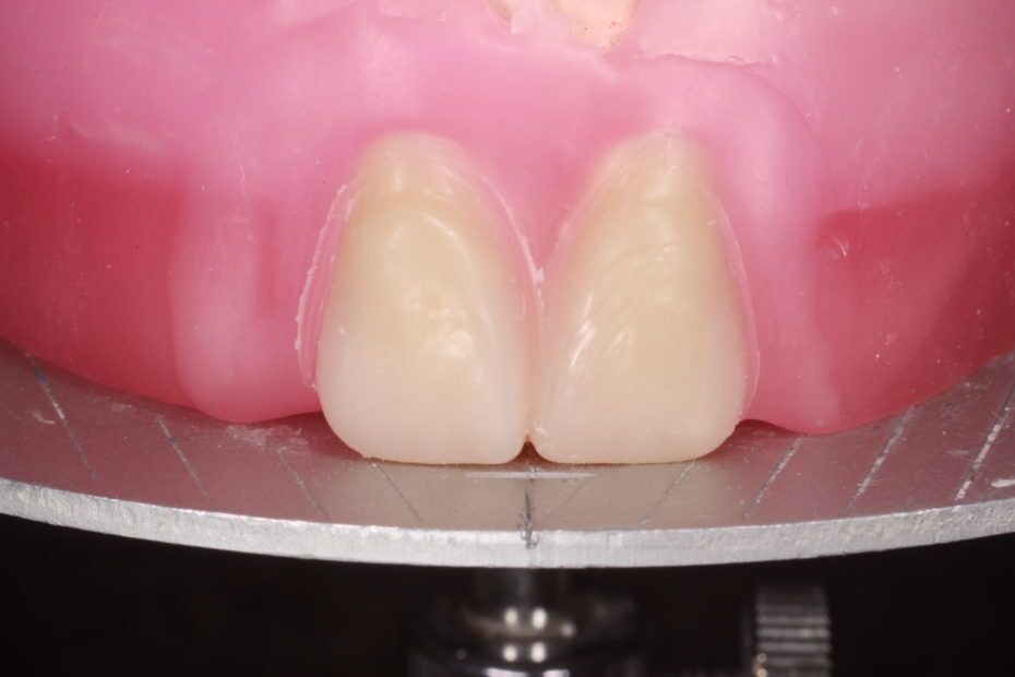 Two Centrals Midline