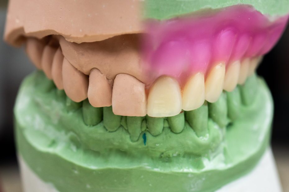 Immediate Denture - Mid Setup