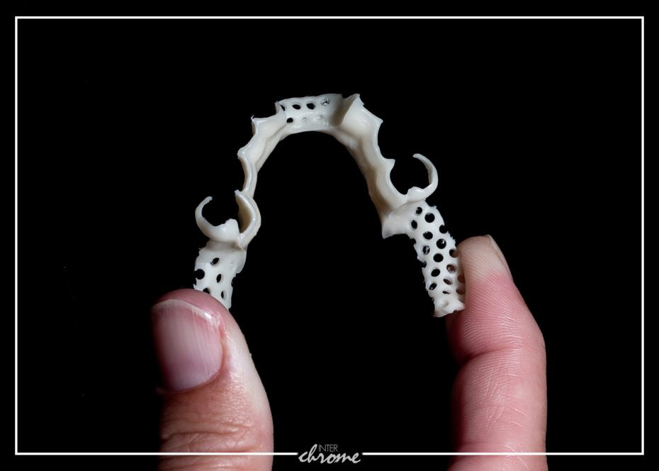 Non Metal partial frame flexing