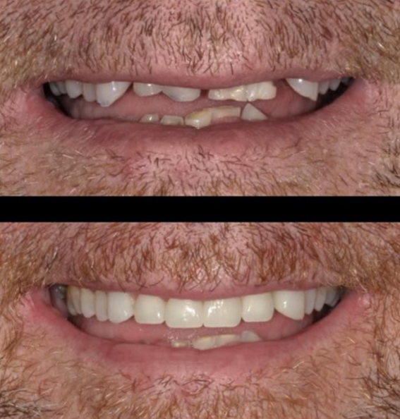 before after front teeth
